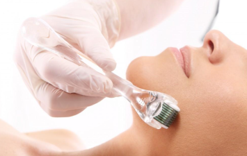 Why Microneedling Is Still So Popular